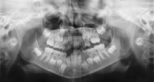 Dental Radiographs (X-Rays) at Pediatric Dentist Office in Clarks Summit