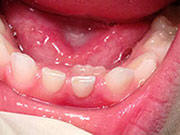 Adult Tooth Behind Baby Tooth at Pediatric Dentist Office in Clarks Summit