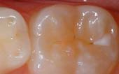Tooth Before Sealant at Pediatric Dentist Office in Clarks Summit
