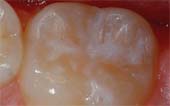 Tooth After Sealant at Pediatric Dentist Office in Clarks Summit